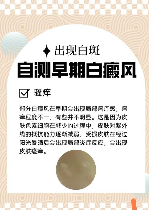 判断白癜和白斑,怎么区分白斑还是白癜风